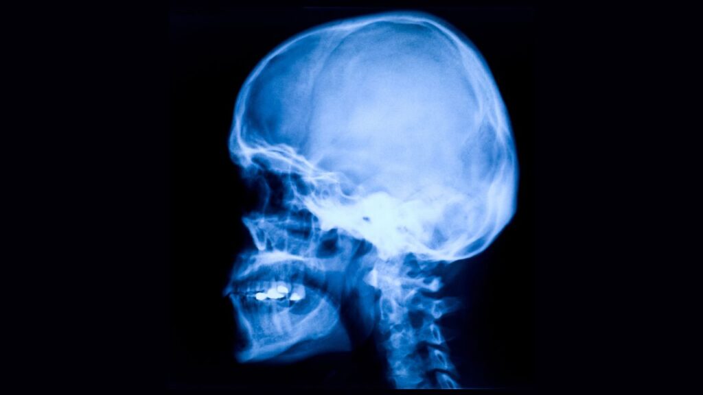 El rol de la neurorehabilitación posterior a un ICTUS 1 neurorehabilitación